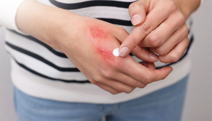Bôi kẽm oxit giúp giảm triệu chứng