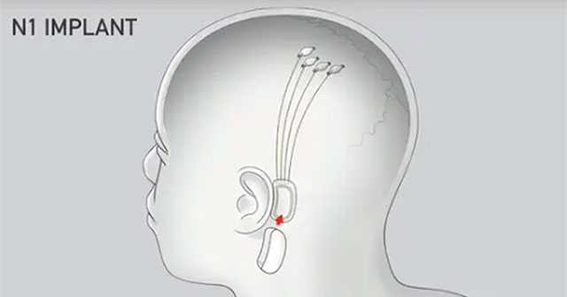 Khám Phá Những Tiềm Năng Của Công Nghệ Cấy Chip Não Của Neuralink