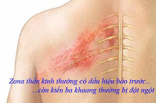 Tổn thương do kiến ba khoang xuất hiện nhanh chóng