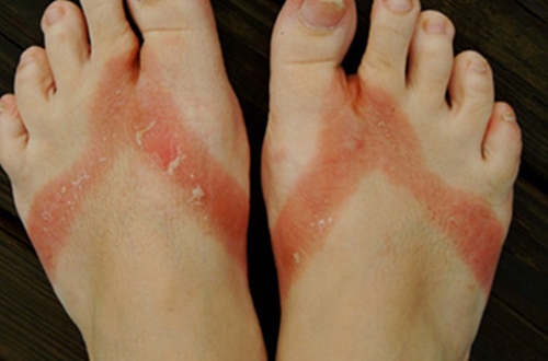 Chân bạn dễ bị cháy nắng khi đi dép xỏ ngón.