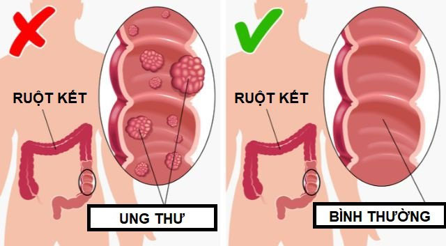 loi-ich-khi-an-dua-chuot-moi-ngay-2 Ngừa bệnh ung thư