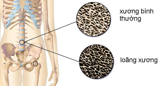 4 Loại Thực Phẩm Cần Tránh Để Bảo Vệ Canxi Trong Cơ Thể