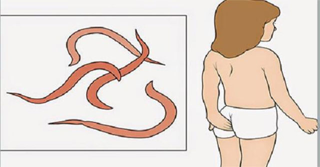 Giun kim ở trẻ: Phát hiện sớm và xử lý tại nhà an toàn cho phụ huynh